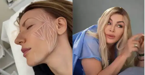 Білик вживила енергетичні імпланти, а Нікітюк коле колагенові ін’єкції.