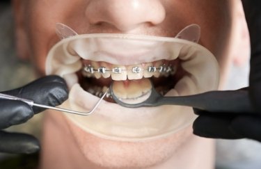 Виправлення прикусу у дорослих: сучасні підходи та варіанти